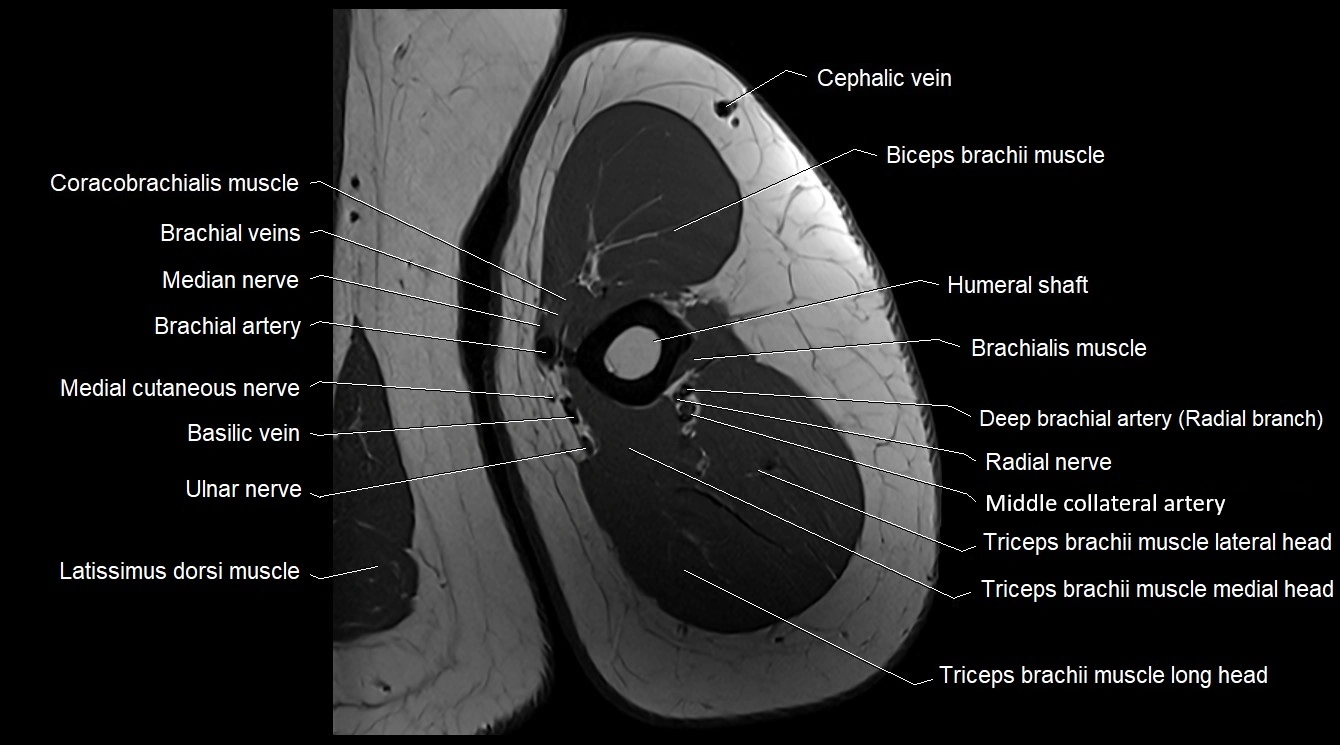 Upper arm( humerus) cross section anatomy MRI 3T axial image 32.webp